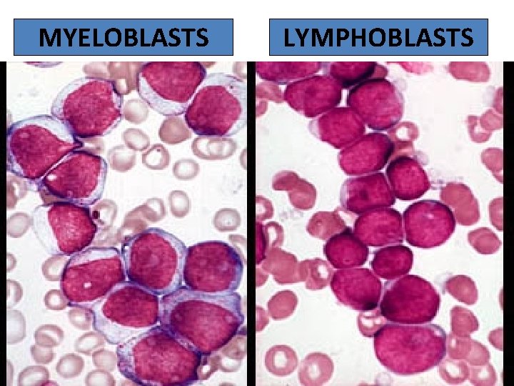 MYELOBLASTS LYMPHOBLASTS 