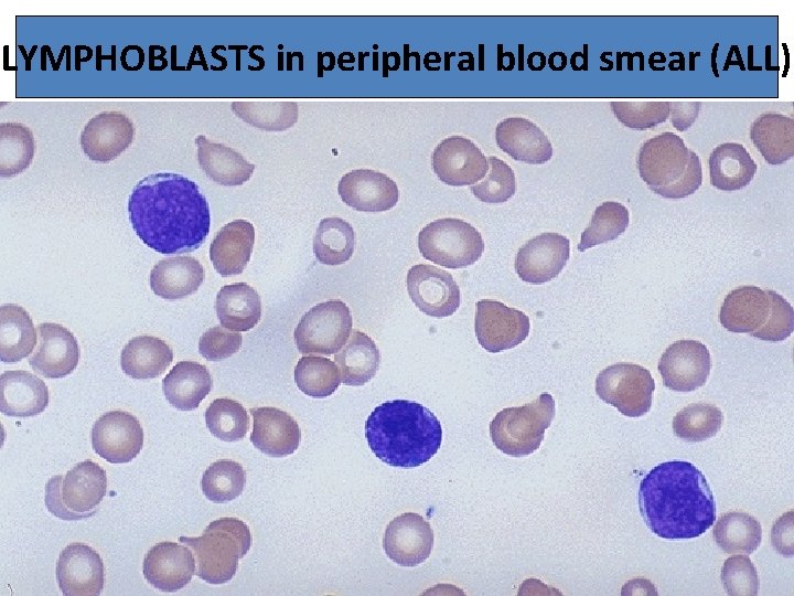 LYMPHOBLASTS in peripheral blood smear (ALL) 