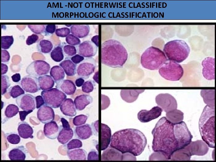 AML -NOT OTHERWISE CLASSIFIED MORPHOLOGIC CLASSIFICATION 
