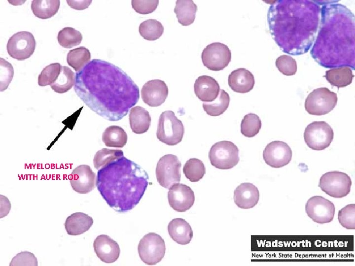 MYELOBLAST WITH AUER ROD 