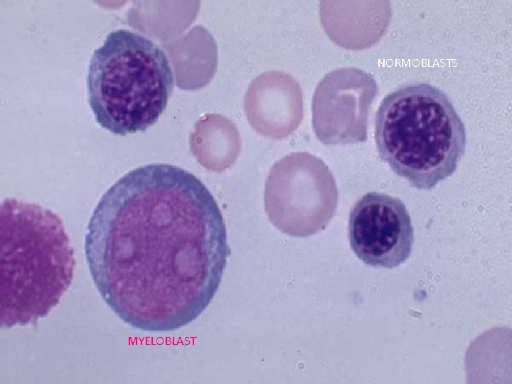 NORMOBLASTS MYELOBLAST 