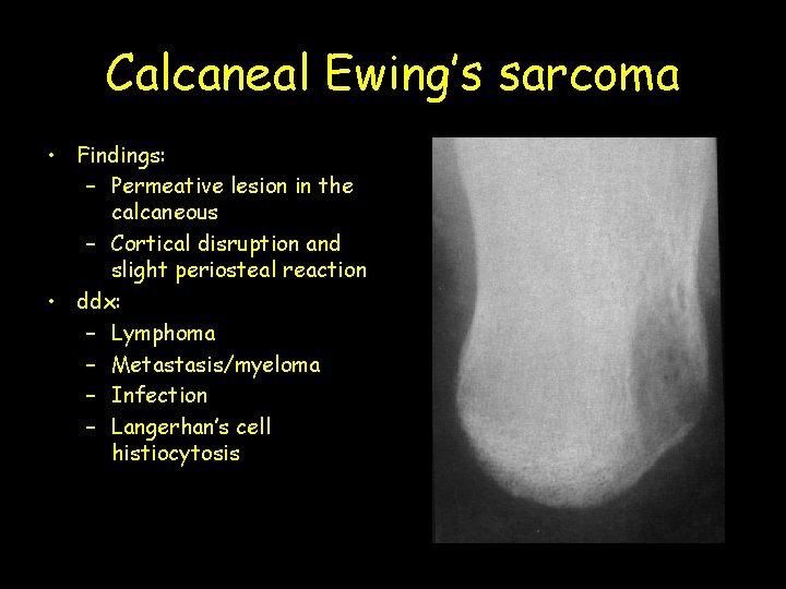 Calcaneal Ewing’s sarcoma • Findings: – Permeative lesion in the calcaneous – Cortical disruption