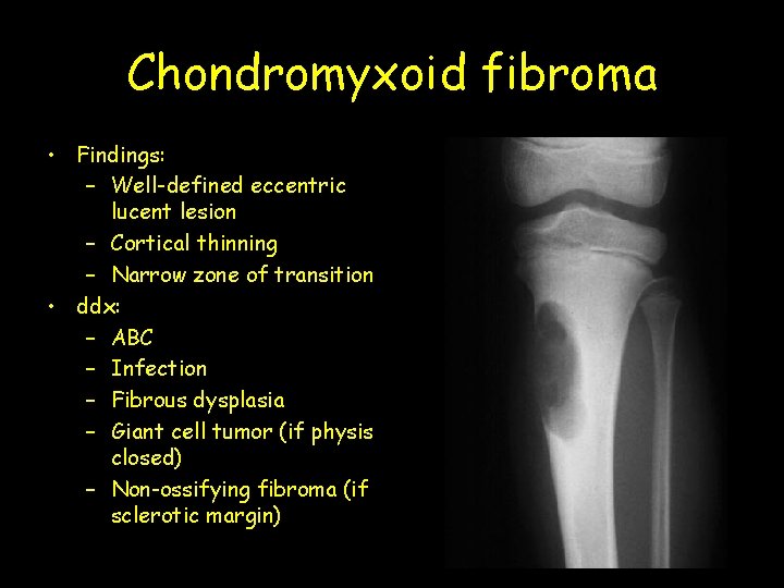 Chondromyxoid fibroma • Findings: – Well-defined eccentric lucent lesion – Cortical thinning – Narrow