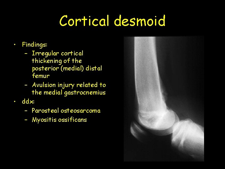 Cortical desmoid • Findings: – Irregular cortical thickening of the posterior (medial) distal femur