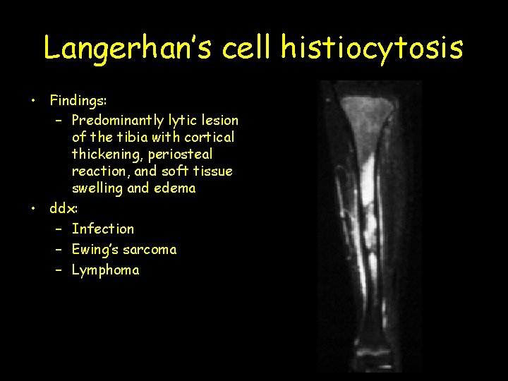 Langerhan’s cell histiocytosis • Findings: – Predominantly lytic lesion of the tibia with cortical