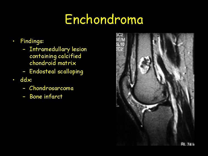 Enchondroma • Findings: – Intramedullary lesion containing calcified chondroid matrix – Endosteal scalloping •