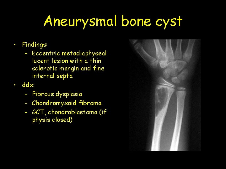 Aneurysmal bone cyst • Findings: – Eccentric metadiaphyseal lucent lesion with a thin sclerotic
