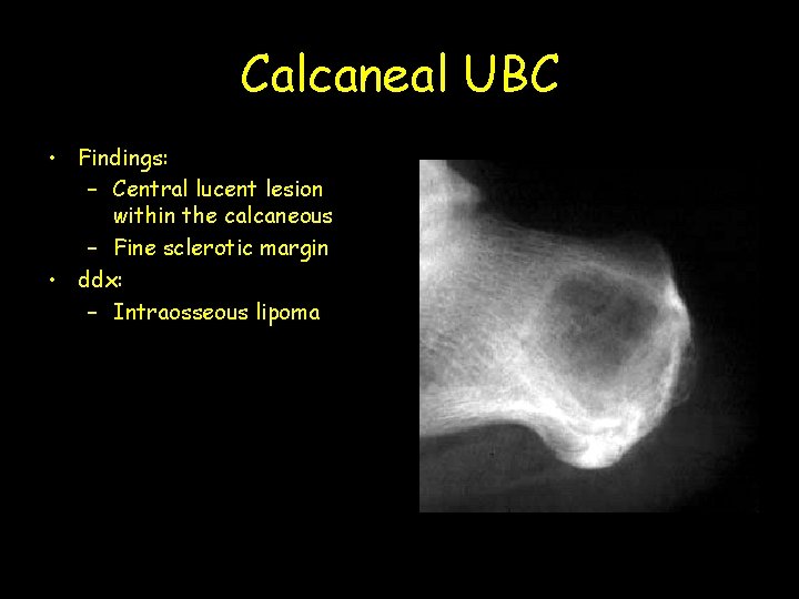 Calcaneal UBC • Findings: – Central lucent lesion within the calcaneous – Fine sclerotic