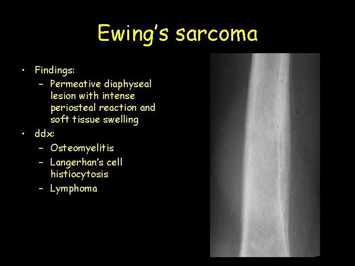 Ewing’s sarcoma • Findings: – Permeative diaphyseal lesion with intense periosteal reaction and soft