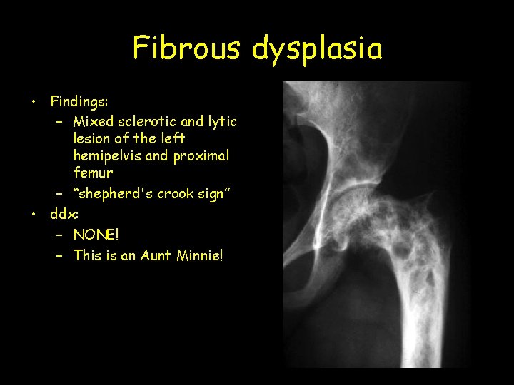 Fibrous dysplasia • Findings: – Mixed sclerotic and lytic lesion of the left hemipelvis