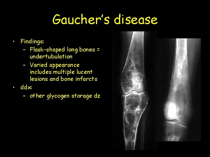 Gaucher’s disease • Findings: – Flask-shaped long bones = undertubulation – Varied appearance includes