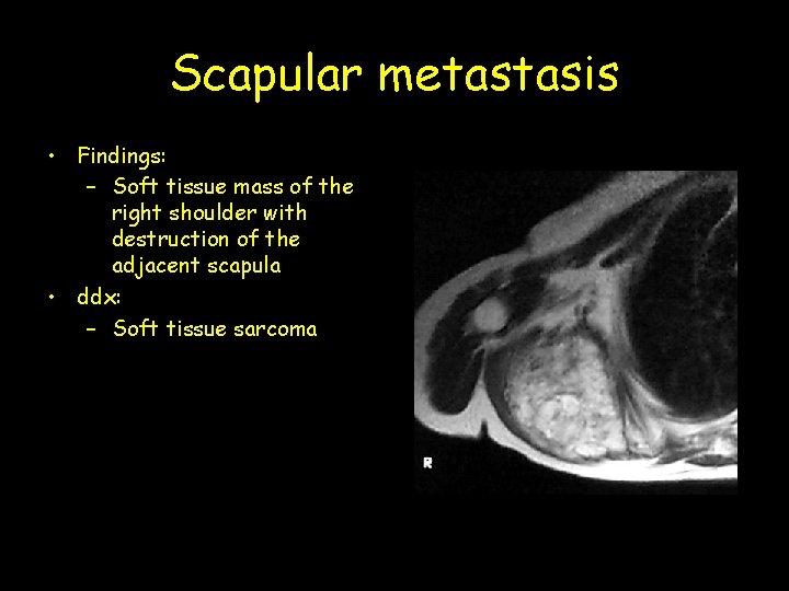 Scapular metastasis • Findings: – Soft tissue mass of the right shoulder with destruction