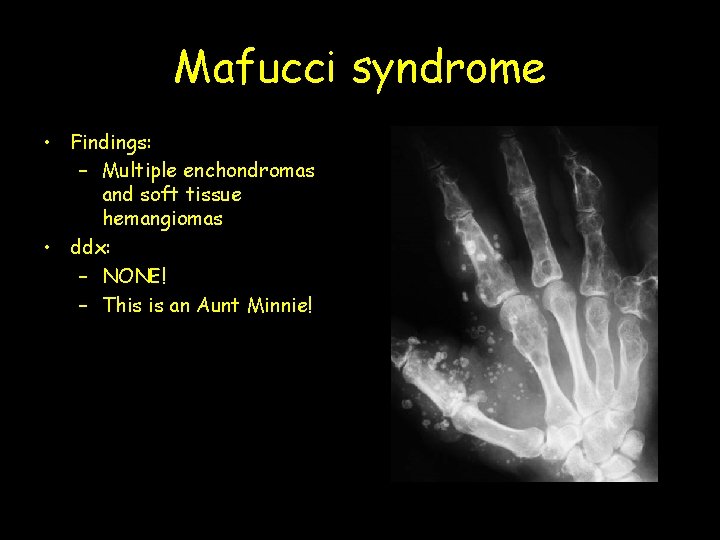 Mafucci syndrome • Findings: – Multiple enchondromas and soft tissue hemangiomas • ddx: –