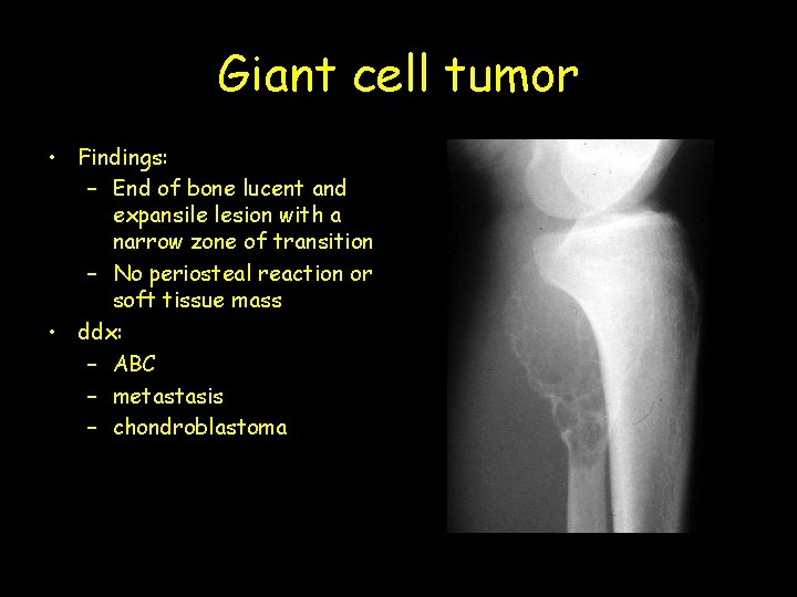 Giant cell tumor • Findings: – End of bone lucent and expansile lesion with