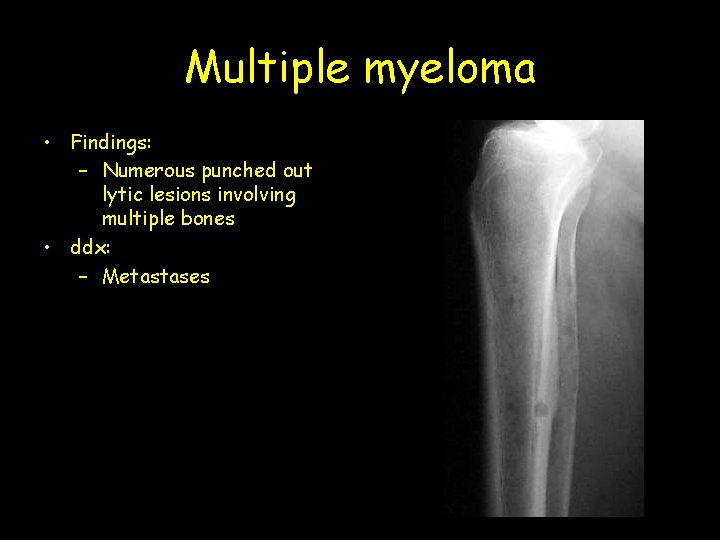 Multiple myeloma • Findings: – Numerous punched out lytic lesions involving multiple bones •