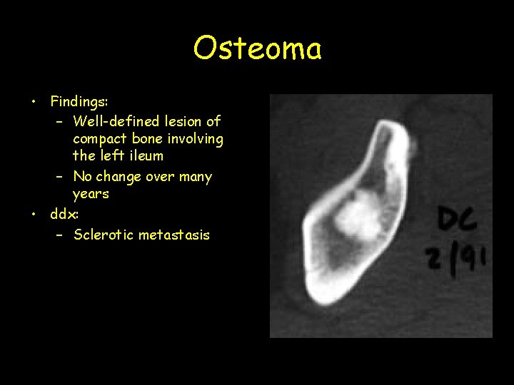 Osteoma • Findings: – Well-defined lesion of compact bone involving the left ileum –