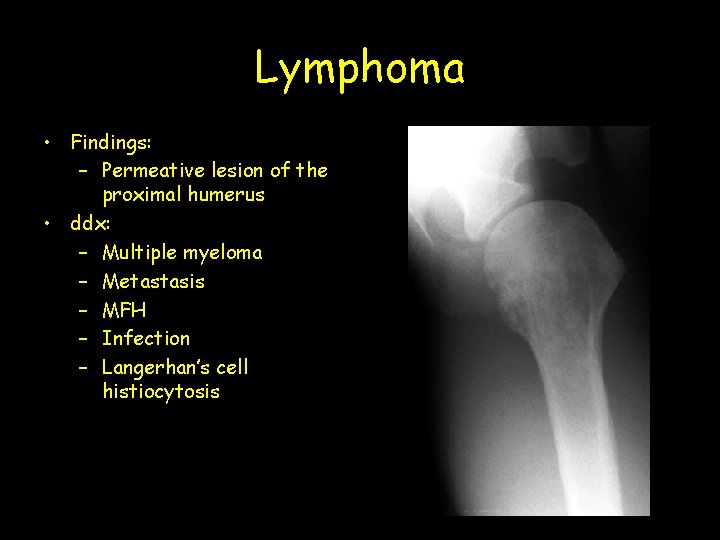 Lymphoma • Findings: – Permeative lesion of the proximal humerus • ddx: – Multiple