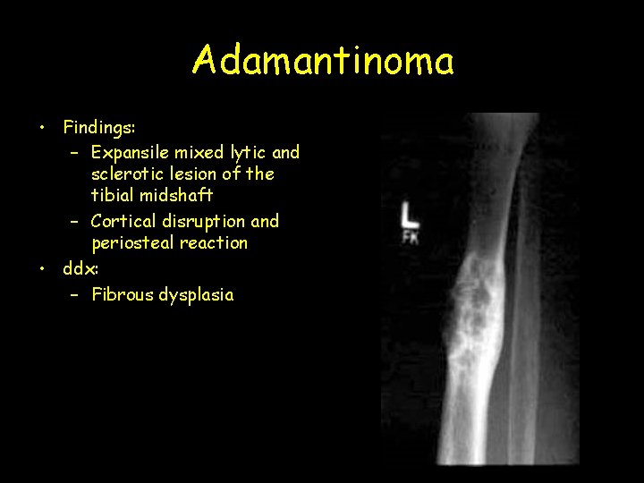 Adamantinoma • Findings: – Expansile mixed lytic and sclerotic lesion of the tibial midshaft