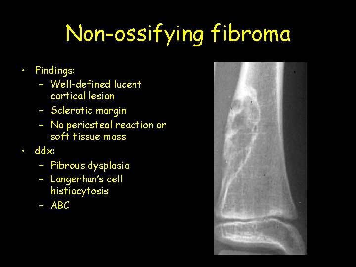 Non-ossifying fibroma • Findings: – Well-defined lucent cortical lesion – Sclerotic margin – No
