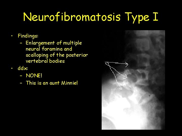 Neurofibromatosis Type I • Findings: – Enlargement of multiple neural foramina and scalloping of