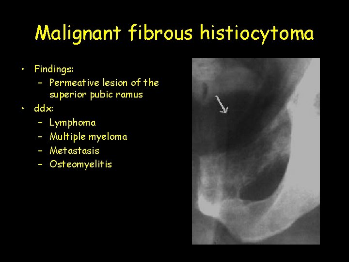Malignant fibrous histiocytoma • Findings: – Permeative lesion of the superior pubic ramus •
