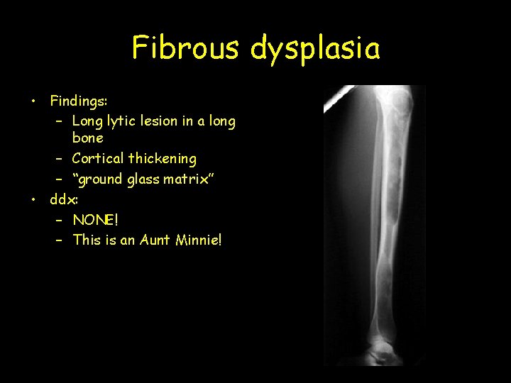 Fibrous dysplasia • Findings: – Long lytic lesion in a long bone – Cortical