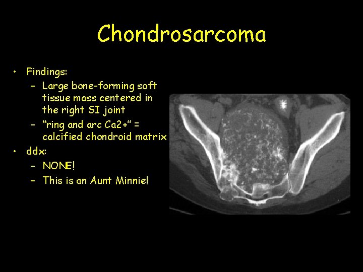 Chondrosarcoma • Findings: – Large bone-forming soft tissue mass centered in the right SI