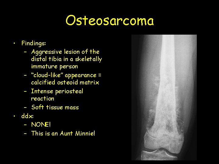 Osteosarcoma • Findings: – Aggressive lesion of the distal tibia in a skeletally immature
