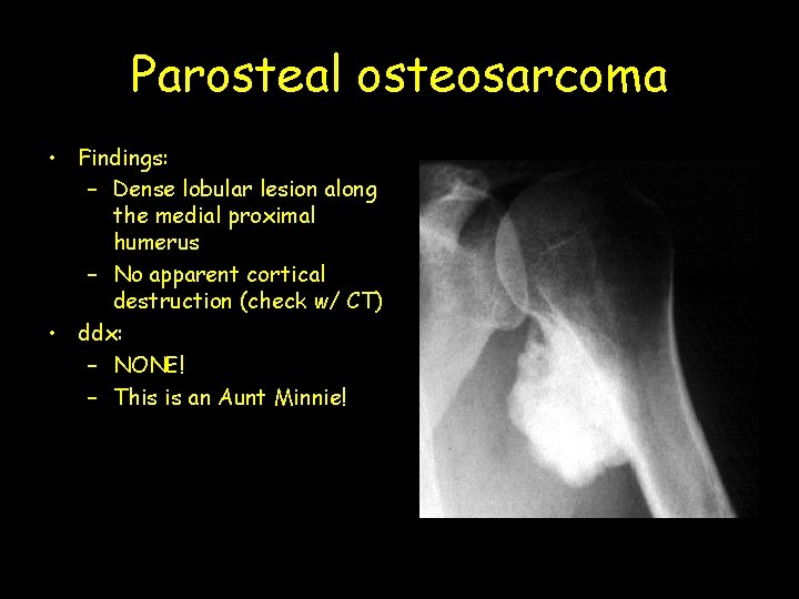 Parosteal osteosarcoma • Findings: – Dense lobular lesion along the medial proximal humerus –