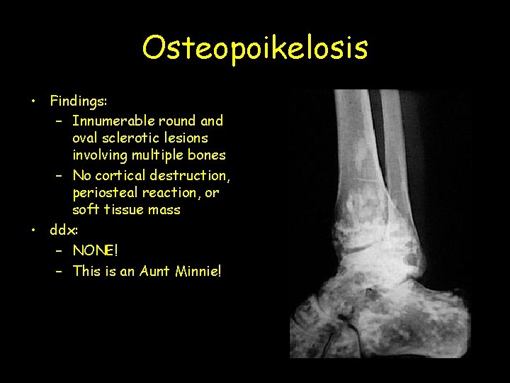 Osteopoikelosis • Findings: – Innumerable round and oval sclerotic lesions involving multiple bones –