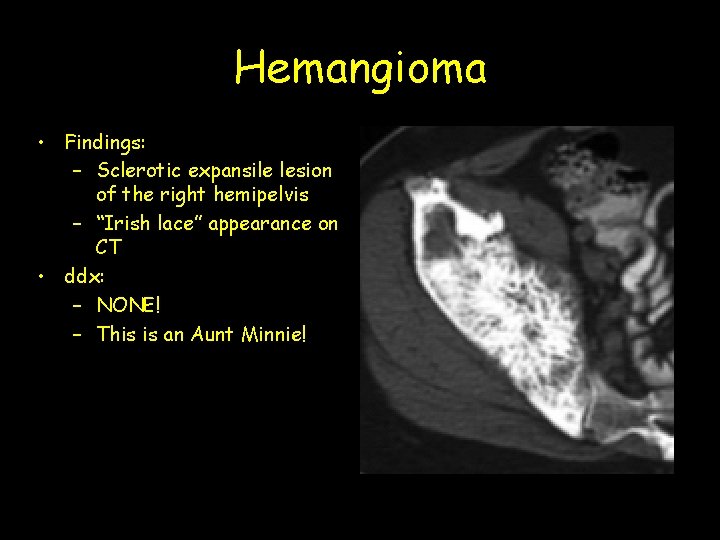 Hemangioma • Findings: – Sclerotic expansile lesion of the right hemipelvis – “Irish lace”