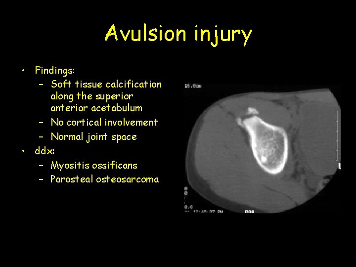 Avulsion injury • Findings: – Soft tissue calcification along the superior anterior acetabulum –