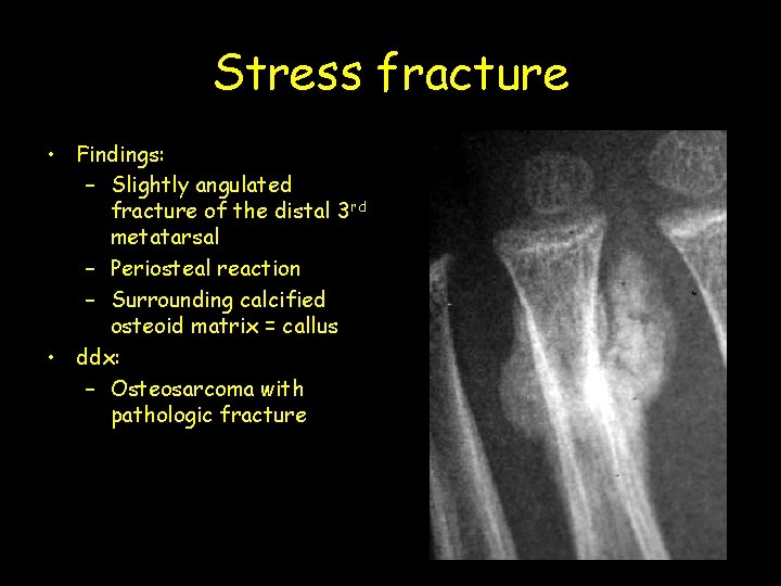 Stress fracture • Findings: – Slightly angulated fracture of the distal 3 rd metatarsal