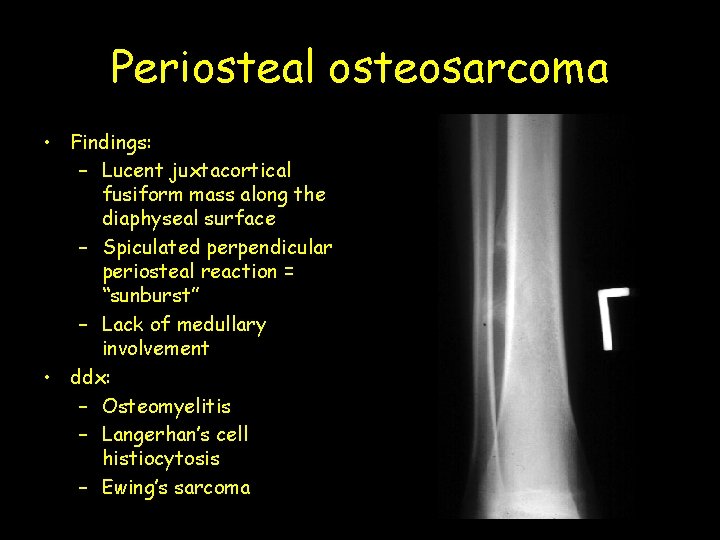 Periosteal osteosarcoma • Findings: – Lucent juxtacortical fusiform mass along the diaphyseal surface –