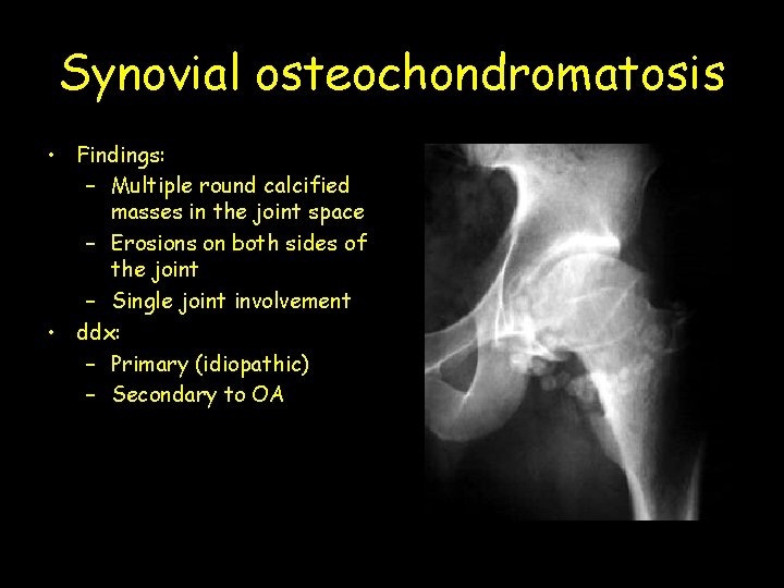 Synovial osteochondromatosis • Findings: – Multiple round calcified masses in the joint space –