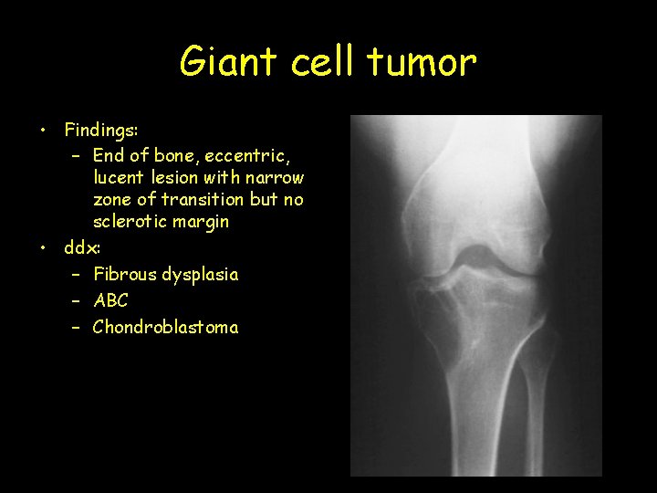 Giant cell tumor • Findings: – End of bone, eccentric, lucent lesion with narrow