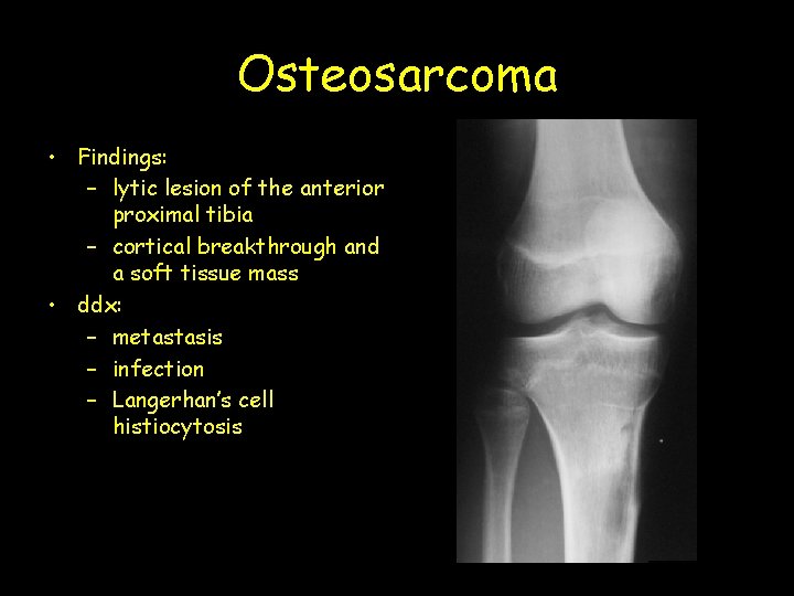 Osteosarcoma • Findings: – lytic lesion of the anterior proximal tibia – cortical breakthrough