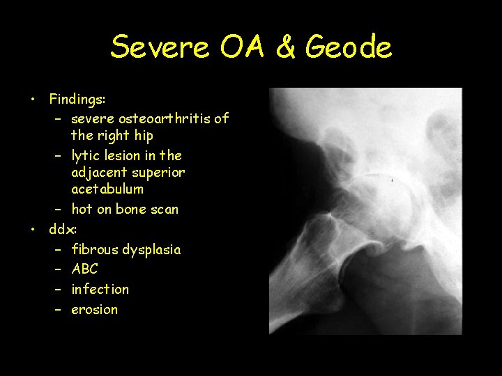 Severe OA & Geode • Findings: – severe osteoarthritis of the right hip –