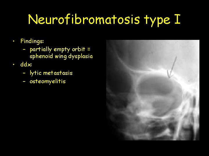 Neurofibromatosis type I • Findings: – partially empty orbit = sphenoid wing dysplasia •