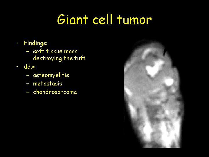 Giant cell tumor • Findings: – soft tissue mass destroying the tuft • ddx:
