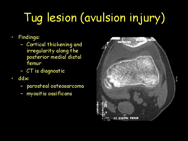 Tug lesion (avulsion injury) • Findings: – Cortical thickening and irregularity along the posterior