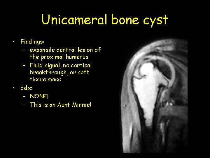 Unicameral bone cyst • Findings: – expansile central lesion of the proximal humerus –