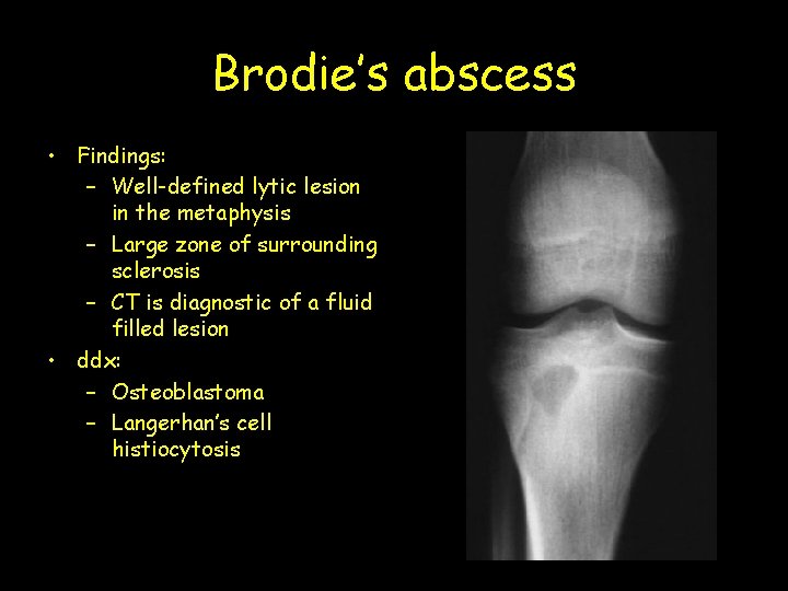Brodie’s abscess • Findings: – Well-defined lytic lesion in the metaphysis – Large zone