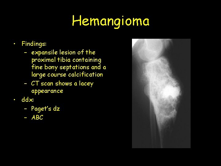 Hemangioma • Findings: – expansile lesion of the proximal tibia containing fine bony septations