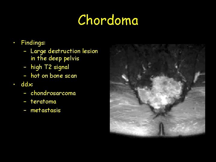 Chordoma • Findings: – Large destruction lesion in the deep pelvis – high T