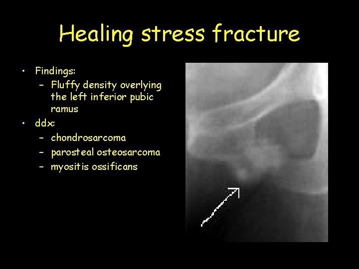 Healing stress fracture • Findings: – Fluffy density overlying the left inferior pubic ramus