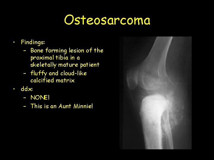 Osteosarcoma • Findings: – Bone forming lesion of the proximal tibia in a skeletally