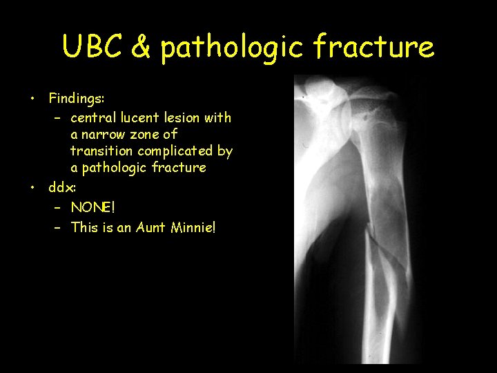UBC & pathologic fracture • Findings: – central lucent lesion with a narrow zone
