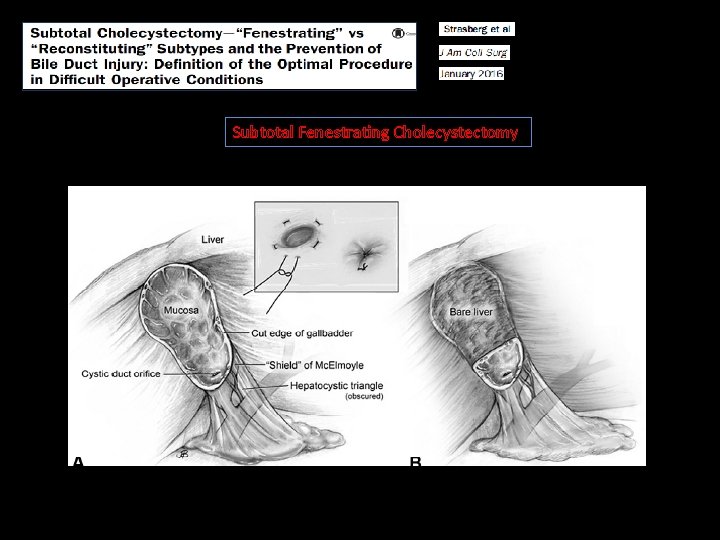 Subtotal Fenestrating Cholecystectomy 