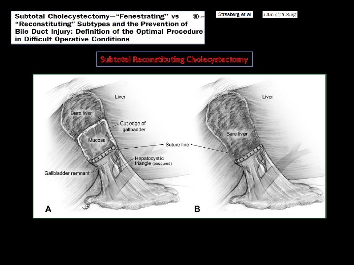 Subtotal Reconstituting Cholecystectomy 